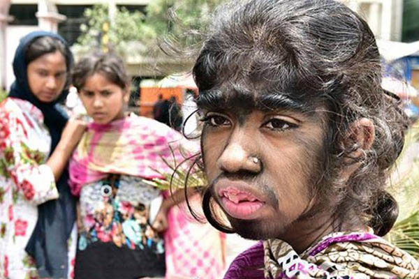 টাঙ্গাইলে অদ্ভুত সমস্যায় স্কুলছাত্রী বীথি ।।