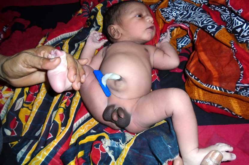 মাগুরায় দুই পুরুষাঙ্গ নিয়ে শিশুর জন্ম.....