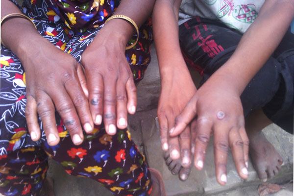 সিরাজগঞ্জের উল্লাপাড়ায় ফের ১৮ জন অ্যানথ্রাক্স রোগী শনাক্ত।।   