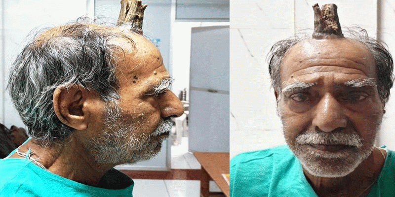 বৃদ্ধের মাথায় ৪ ইঞ্চি লম্বা শিং॥