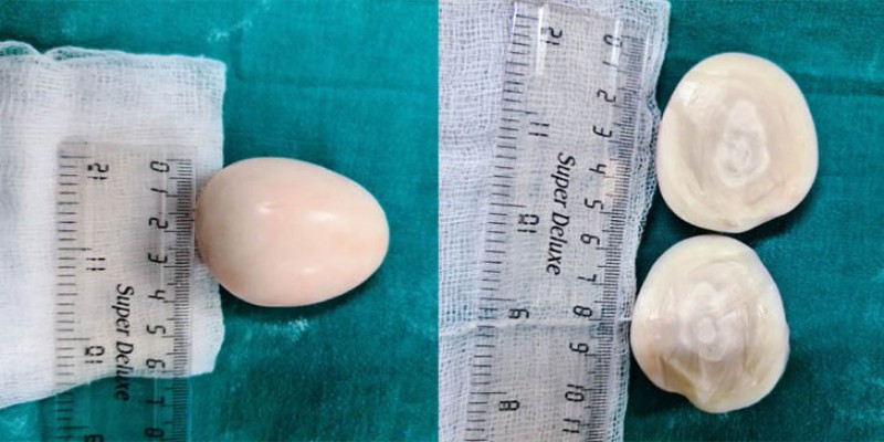 টিউমার ভেবে অস্ত্রোপচারের পর মিলল আস্ত ‘সিদ্ধ ডিম’!