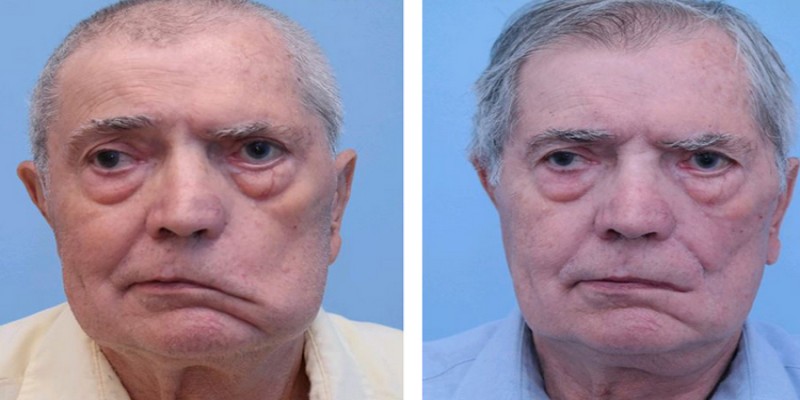 করোনা টিকা নেওয়ার পর চেহারা বিকৃত ১৩ জনের॥